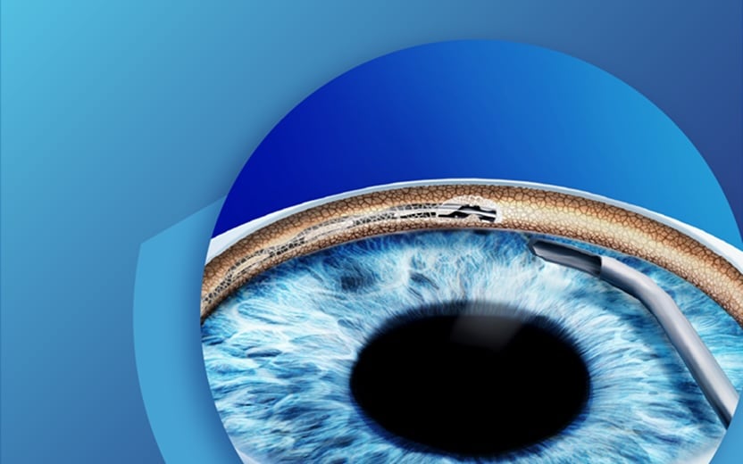 Close-up illustration of a blue eye with a surgical instrument and small implant near the iris